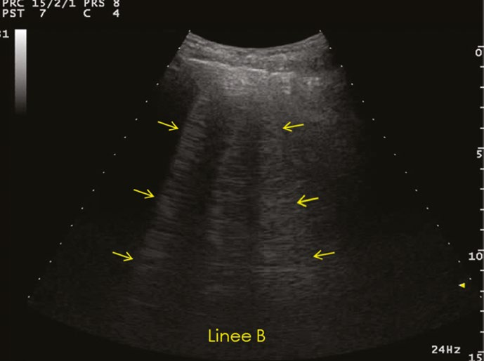 Immagine ecografica polmonare con multiple linee B verticali iperecogene segnalate da frecce gialle che si estendono dalla linea pleurica al fondo dello schermo