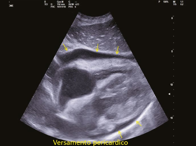 Scansione ecografica sottocostale che mostra versamento pericardico come falda anecogena attorno al cuore