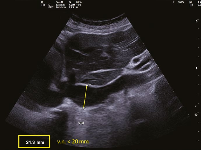 Scansione ecografica longitudinale della vena cava inferiore dilatata con diametro misurato di 24,3 mm rispetto al valore normale inferiore a 20 mm