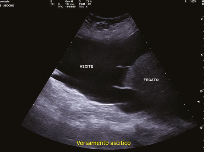 Scansione ecografica addominale che mostra ascite come ampia falda anecogena adiacente al fegato
