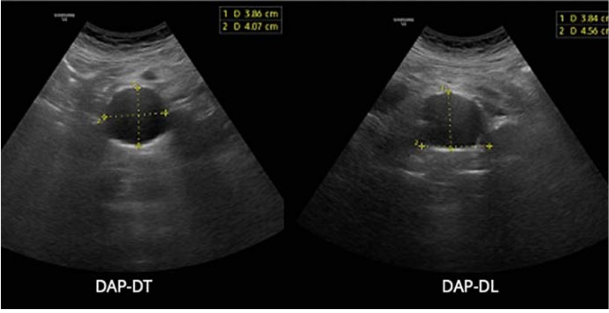 Due immagini ecografiche in scala di grigi affiancate, ottenute con sonda convex, che mostrano l'aorta addominale dilatata come struttura anecogena rotondeggiante circondata dai tessuti retroperitoneali. Nella scansione trasversale a sinistra, etichettata DAP-DT, i cursori riportano i diametri di 3.86 cm e 4.07 cm; nella scansione longitudinale a destra, etichettata DAP-DL, i diametri misurati sono 3.84 cm e 4.56 cm.