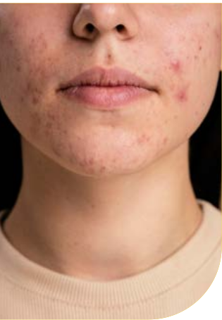 Primo piano del volto e del collo di una giovane donna con lesioni acneiche infiammatorie su mento, guance e regione mandibolare