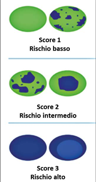 Schema in tre riquadri sovrapposti: Score 1 mostra due noduli prevalentemente verdi (elastici); Score 2 mostra noduli con ampie aree blu alternate al verde; Score 3 mostra due noduli interamente blu (rigidi).
