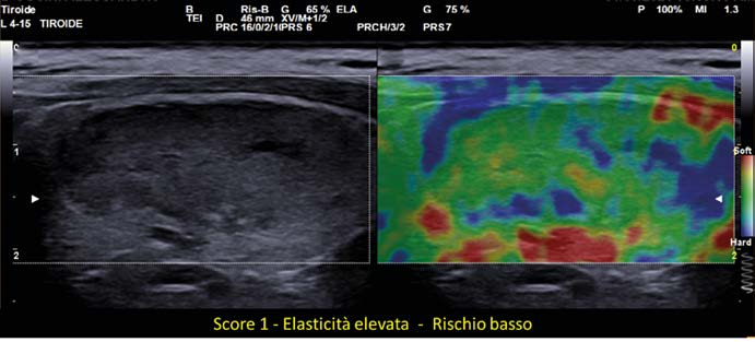 Elastosonografia tiroidea a doppia immagine: a sinistra la scansione B-mode in scala di grigi del nodulo, a destra l'elastogramma con mappa di colori in cui prevalgono verde, giallo e rosso, indice di tessuto soffice.