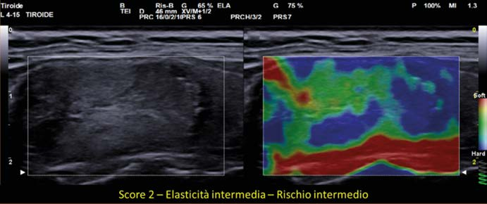 Elastosonografia tiroidea a doppia immagine: a sinistra la scansione B-mode in scala di grigi con box di misura sul nodulo, a destra l'elastogramma con aree verdi e rosse alternate ad ampie zone blu, indice di elasticità intermedia.
