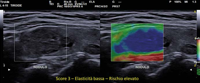 Elastosonografia tiroidea a doppia immagine: a sinistra la scansione B-mode in scala di grigi con il nodulo delimitato e indicato dalla scritta NODULO, a destra l'elastogramma in cui il nodulo appare interamente blu, indice di rigidità elevata.